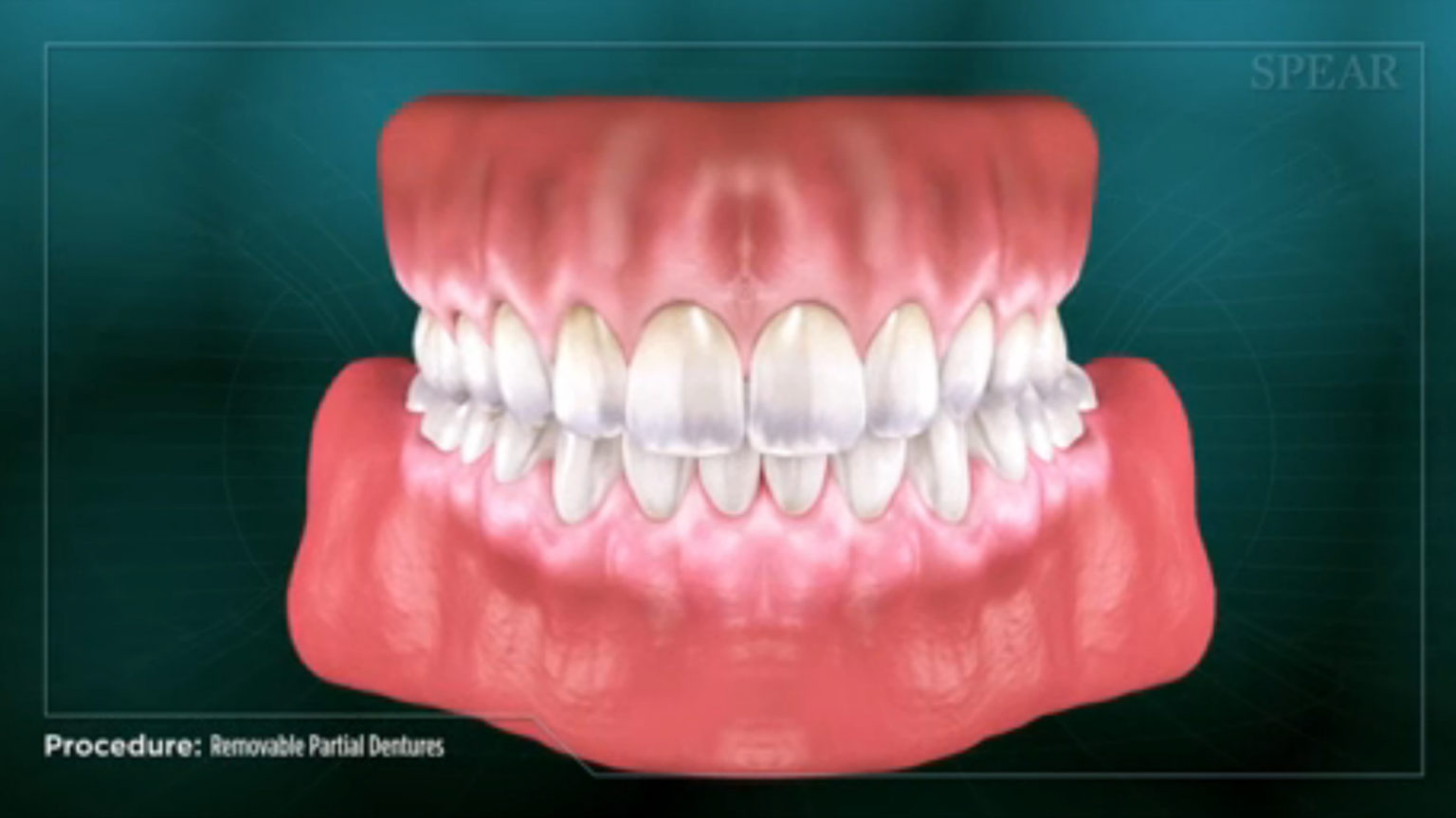 restorativedentalproceduresthumb6 Miami Dental Sedation Spa